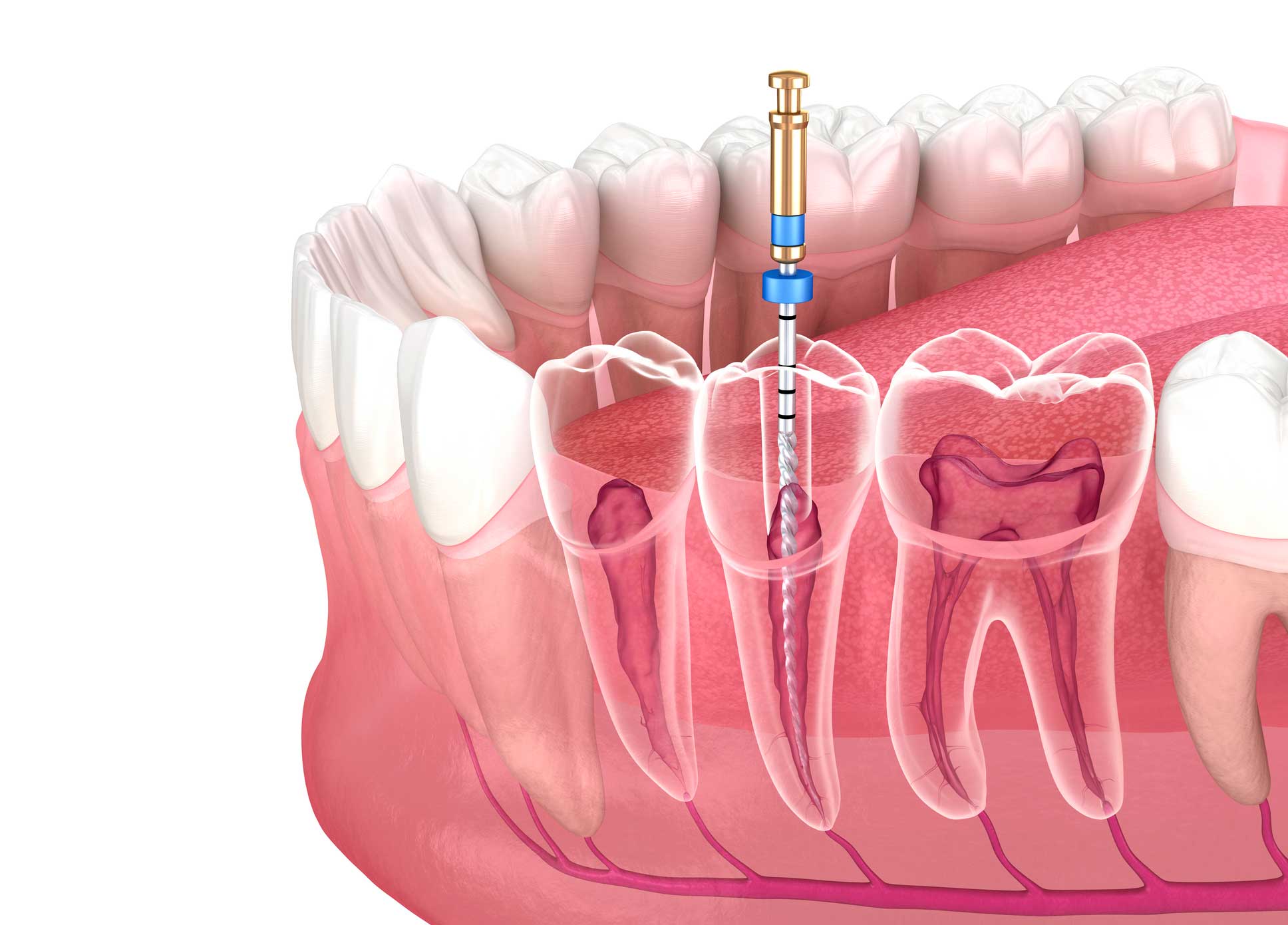 dentista en Riola, Clínica Dental en Riola, endodoncia en Riola