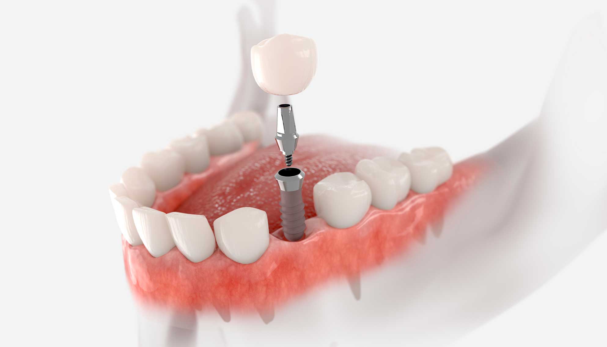 Consejos postoperatorio de implantes dentales.