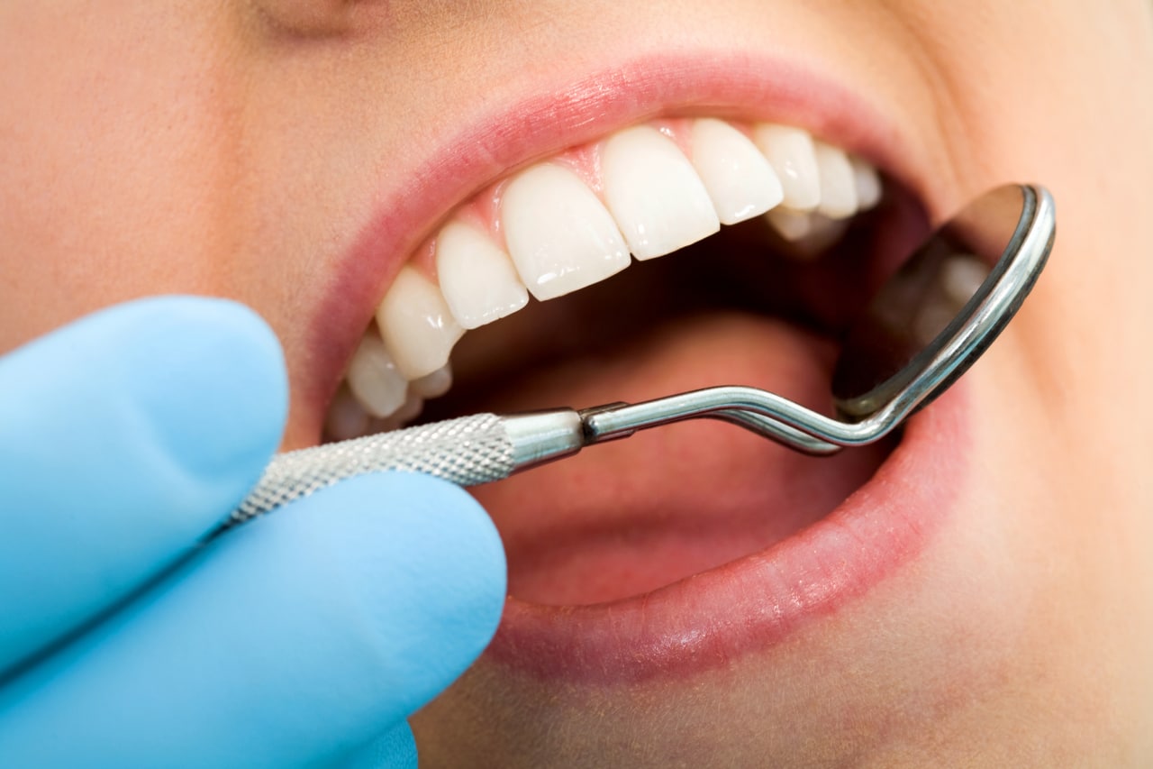 sarro placa dental