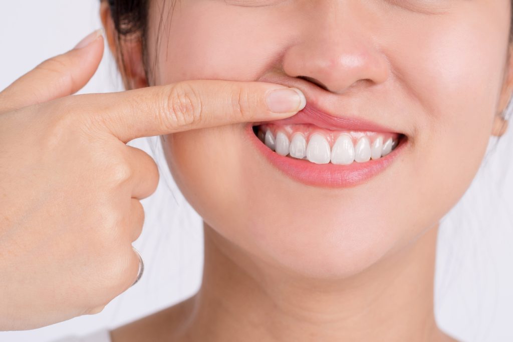 Tratamiento de periodoncia.