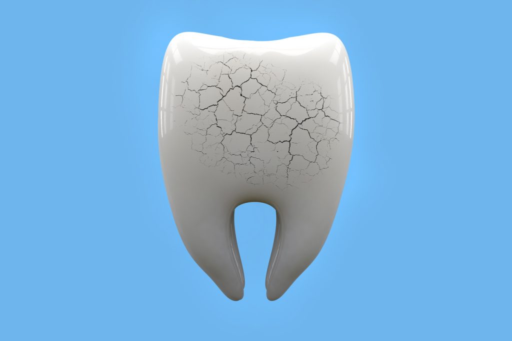 Daños en el esmalte dental.