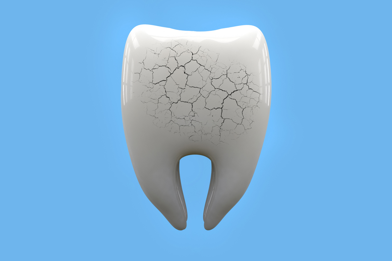 Daños en el esmalte dental.